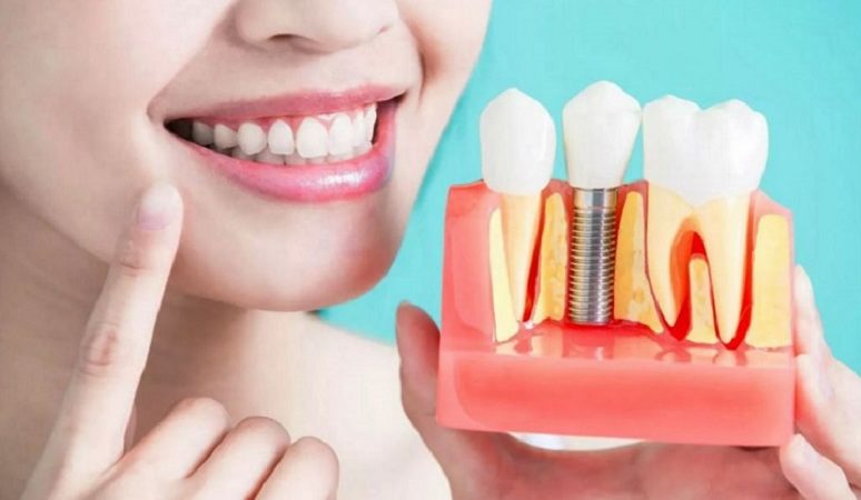 Уход за зубными имплантами, что делать?
